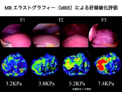 図1. MR エラストグラフィによる肝硬度測定と腹腔鏡の対比