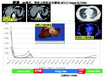 図2. 腫瘍個数5カ所以上の肝がんに対して薬物治療を行った後に切除した症例